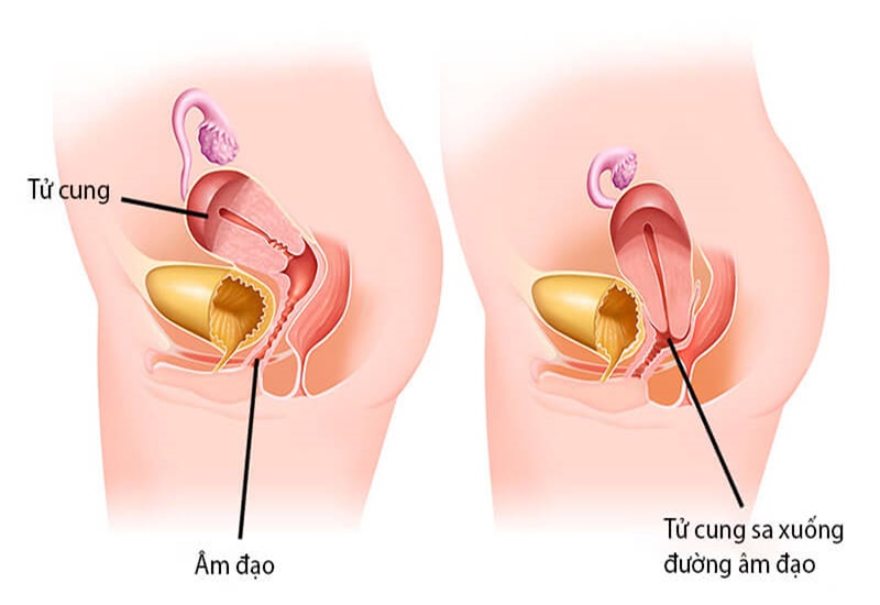 Sa tử cung tiếng Anh là gì Gallery 2