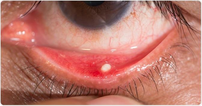 Sạn Vôi Ở Mắt: Nguyên Nhân, Triệu Chứng Và Cách Điều Trị