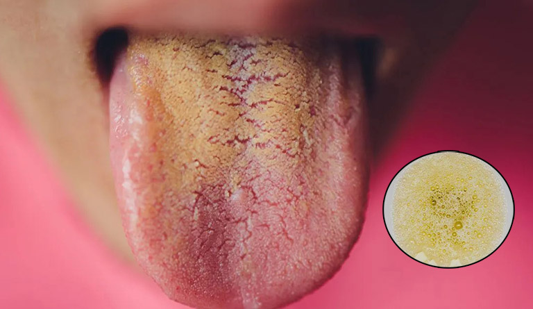 Sáng Ngủ Dậy Nước Bọt Có Màu Vàng: Nguyên Nhân Và Cách Khắc Phục