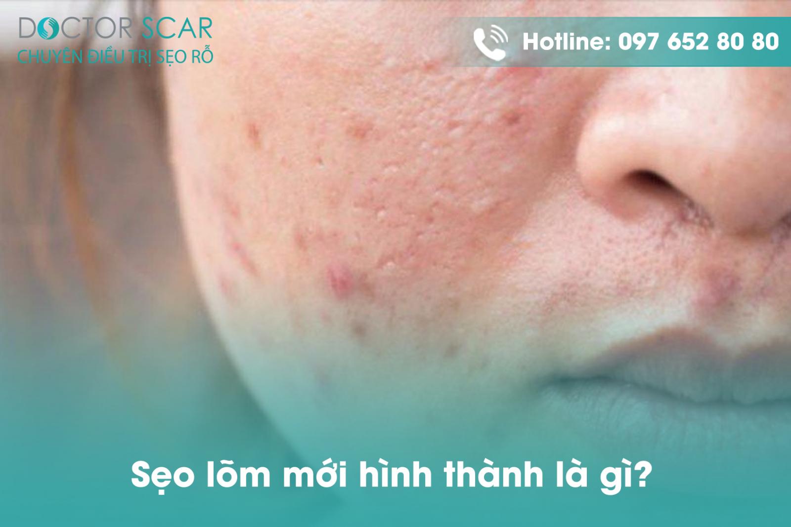 Sẹo lõm mới hình thành: Nguyên nhân, cách điều trị và phòng ngừa