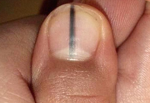 Sọc Đen Ở Móng Chân Cái: Nguyên Nhân, Điều Trị và Phòng Ngừa