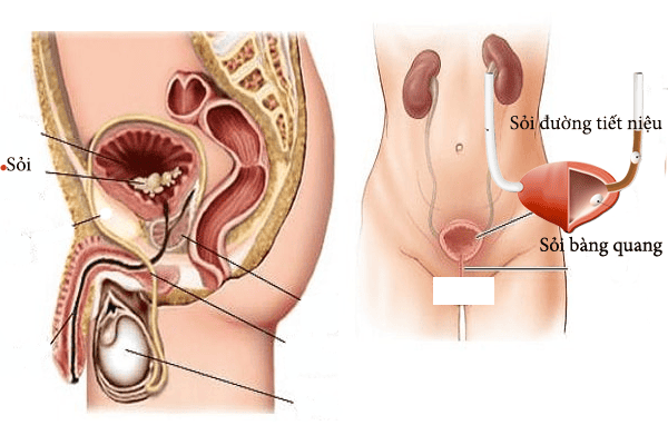 Sỏi Bàng Quang Là Gì?