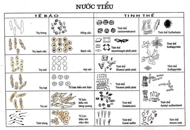 Soi Cặn Lắng Nước Tiểu: Hướng Dẫn Chi Tiết và Giải Đáp Thắc Mắc