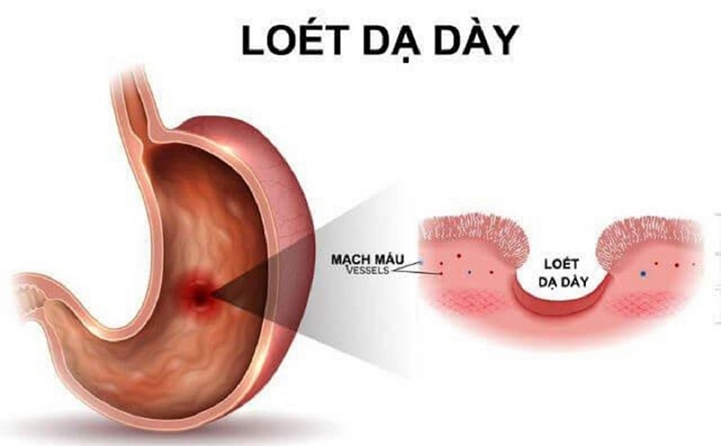 Sốt Ruột Hay Xót Ruột? Sự Khác Biệt Và Cách Khắc Phục Gallery 1