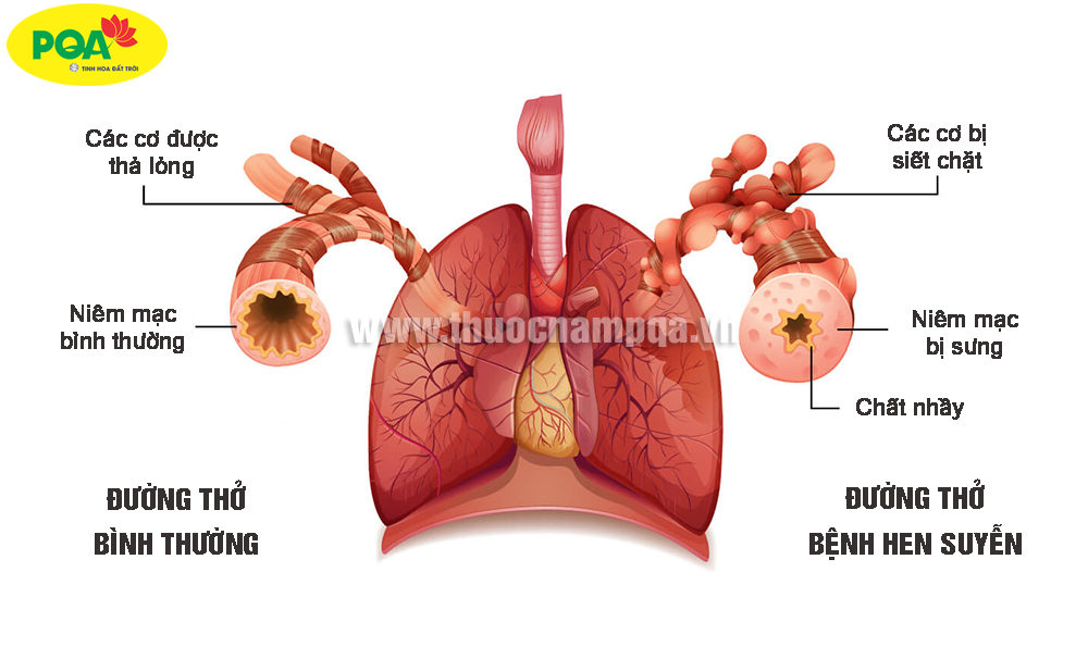 Hen suyễn và hen phế quản có giống nhau không? Gallery 1