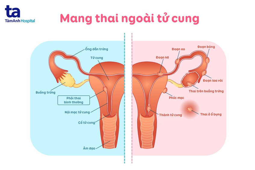 Chửa ngoài dạ con thử que có lên 2 vạch không? Gallery 1
