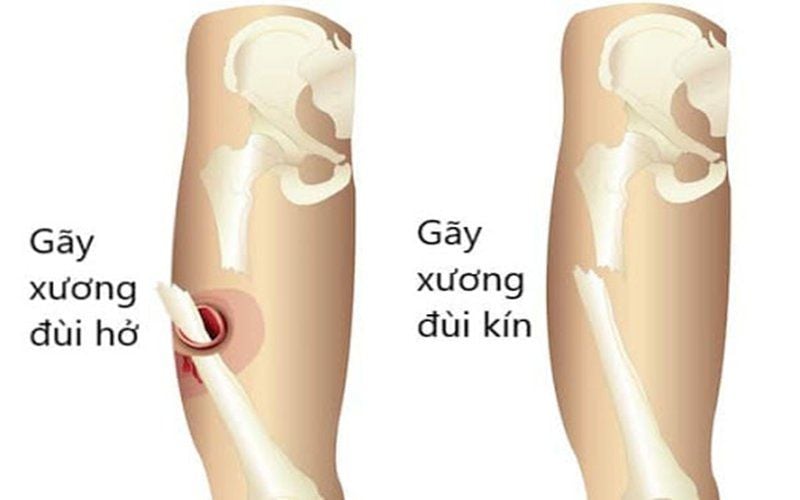 Gẫy hay Gãy? Gallery 1