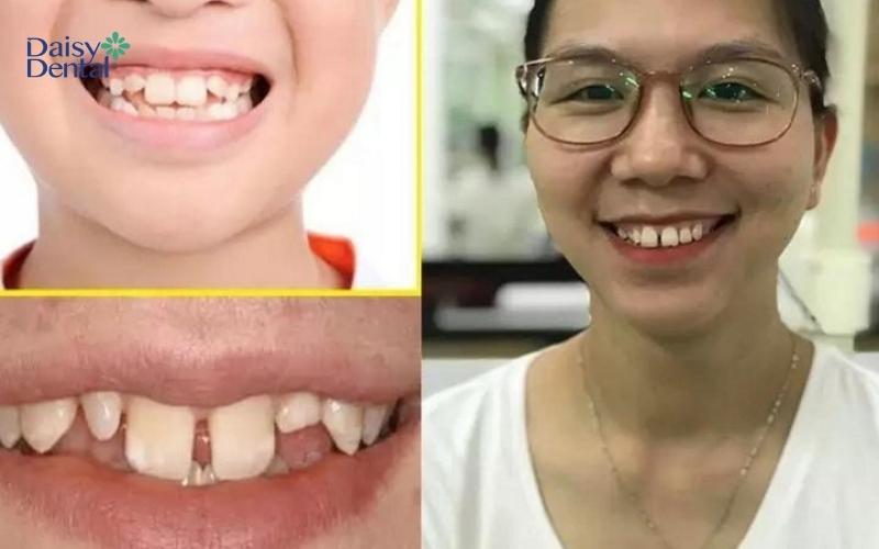 Sự Khác Biệt Giữa Răng Chuột và Răng Thỏ Gallery 2