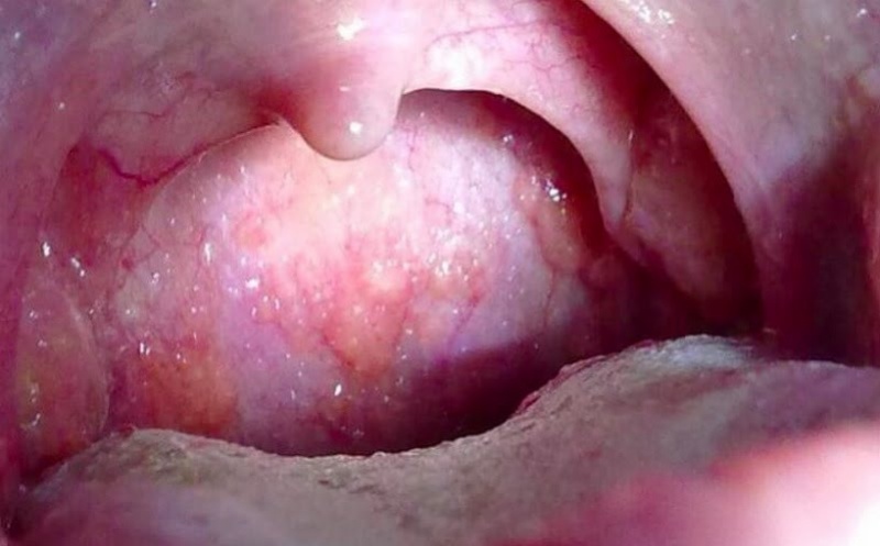 Sùi Vòm Họng Ở Người Lớn