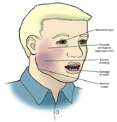 Sưng Quai Hàm Nhưng Không Đau: Nguyên Nhân và Cách Xử Trí