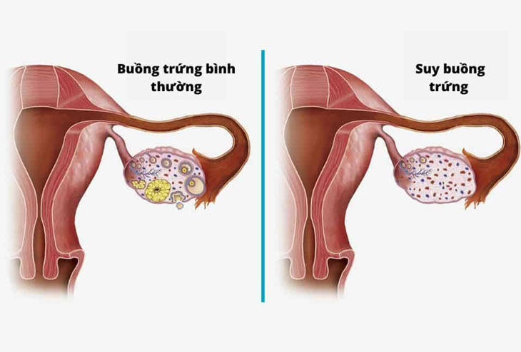 Suy Buồng Trứng Sớm Là Gì?