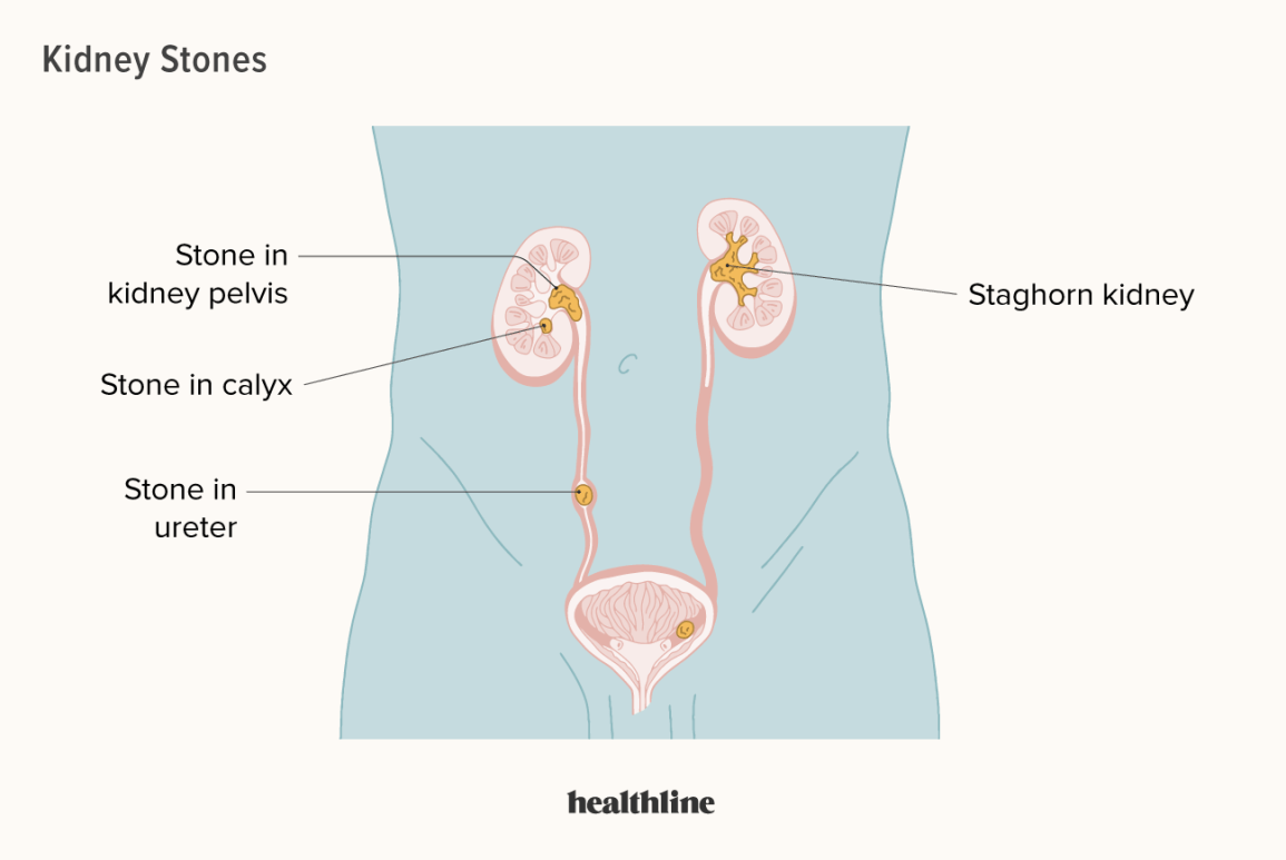 Kidney Stones Gallery 2