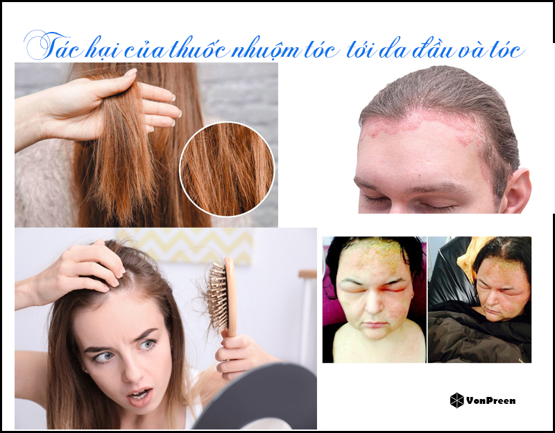 Tác hại của nhuộm tóc - Những rủi ro tiềm ẩn bạn cần biết Gallery 2