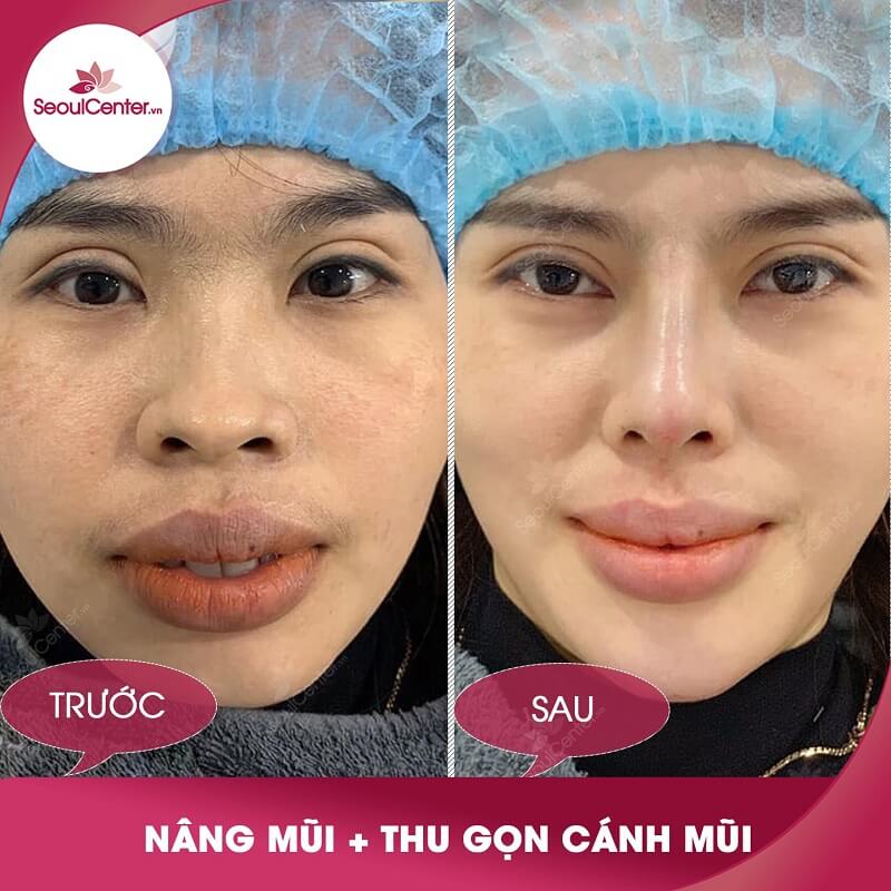 Ngoáy mũi có làm mũi to ra không? Gallery 1