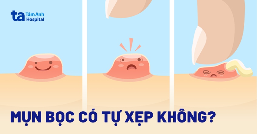 Có Nên Nặn Mụn Bọc? Gallery 1