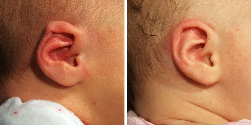 Tai Cụp Vào Trong: Nguyên Nhân, Cách Khắc Phục & Khi Nào Cần Đi Khám