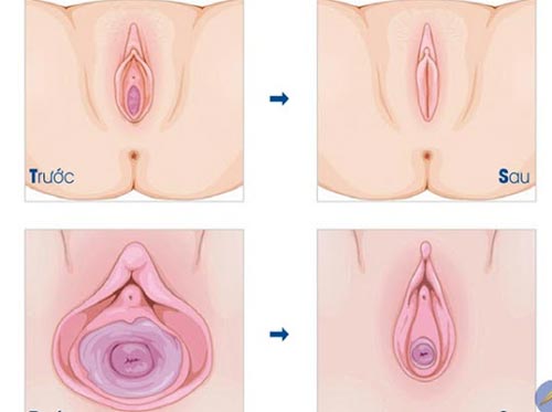 Có mẹ nào thu hẹp vùng kín chưa? Gallery 1