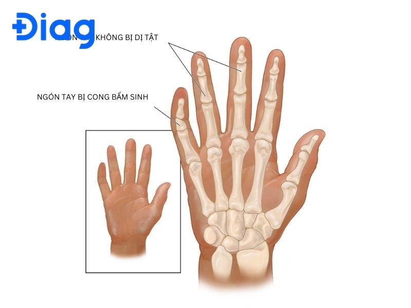 Tại Sao Ngón Tay Út Bị Cong?