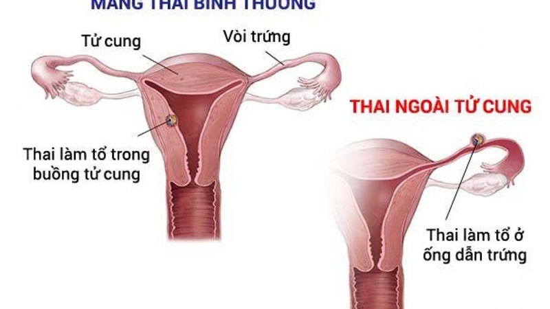 Có thai ngoài tử cung thử que có lên không? Gallery 1