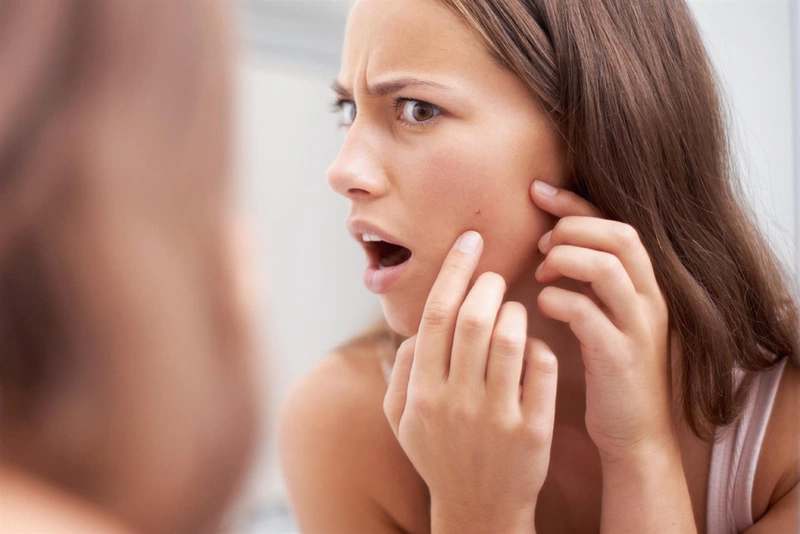 Tại Sao Thức Khuya Lại Nổi Mụn?