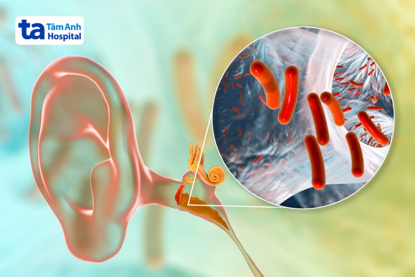 Tai ù bên phải: Nguyên nhân, triệu chứng và cách điều trị