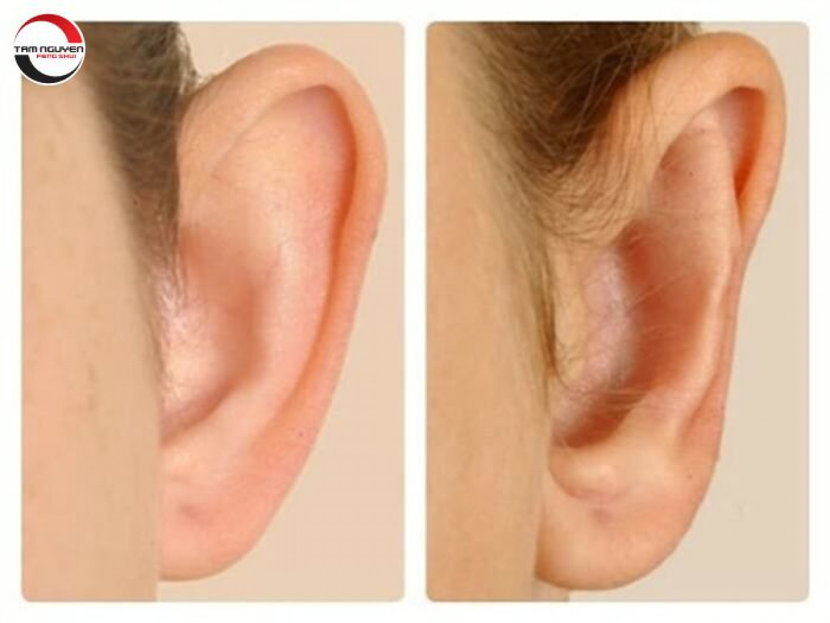 Tai Vểnh Ra Sau: Nguyên Nhân, Khắc Phục Và Những Điều Cần Biết