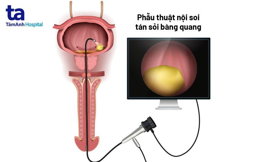 Tán Sỏi Bàng Quang