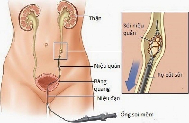 Tán Sỏi Ngược Dòng