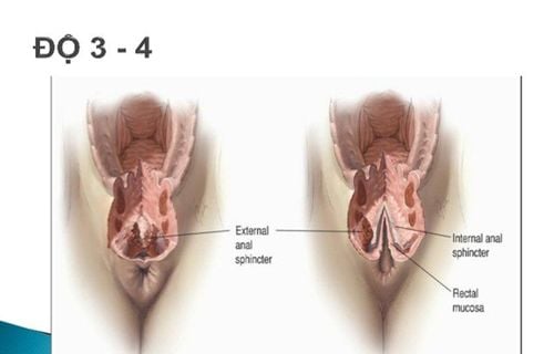 Tầng Sinh Môn Bị Rách Khi Quan Hệ: Nguyên Nhân, Triệu Chứng Và Cách Xử Trí