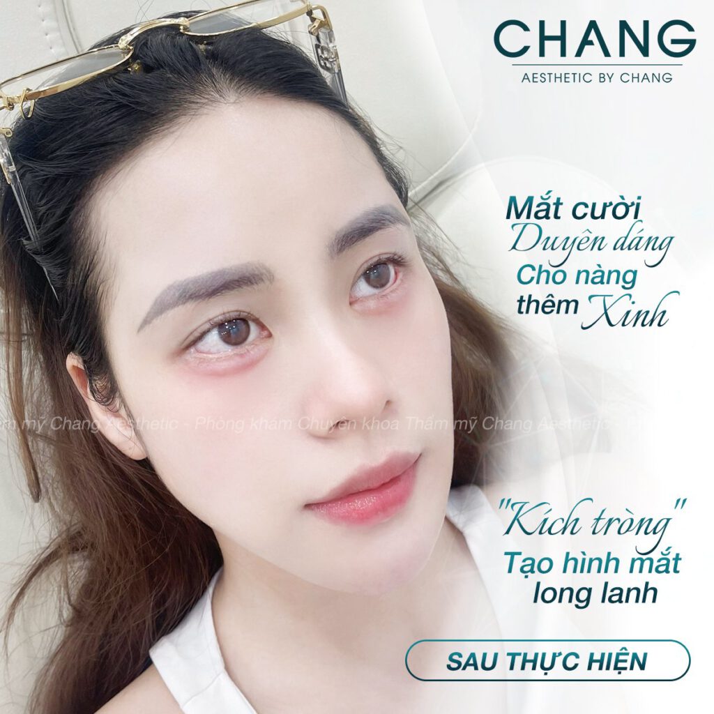 Tạo Bọng Mắt Cười: Hướng Dẫn Chi Tiết Và An Toàn