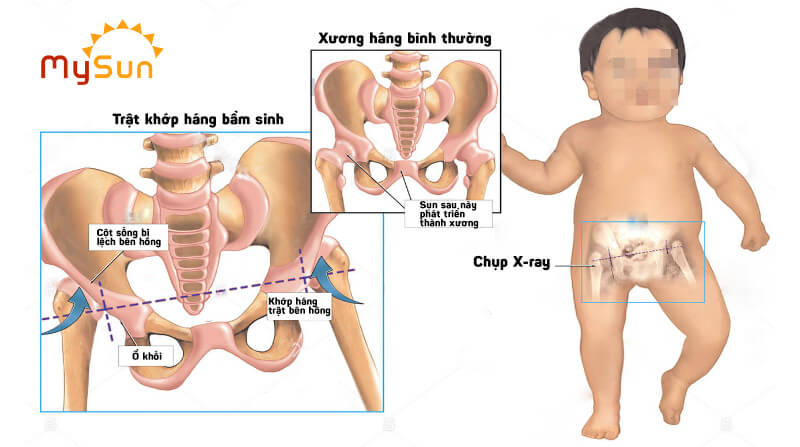 Tập Tễnh Là Gì?