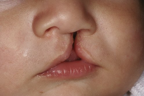 Tật Khe Hở Môi Hàm Là Đột Biến Gì?