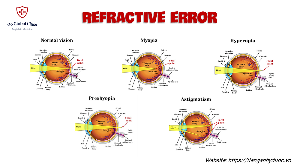 Refractive Errors in English