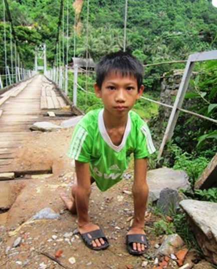 Tật nguyền là gì?