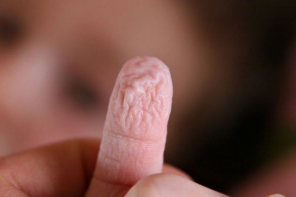 Tay bị phồng rộp: Nguyên nhân, điều trị và phòng ngừa