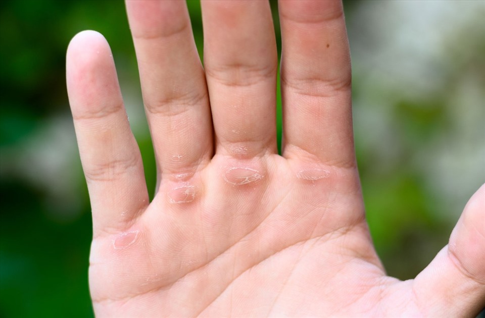 Tay Chai là gì? Nguyên nhân, cách khắc phục và phòng ngừa hiệu quả
