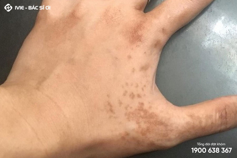 Tay Nổi Đốm Đen: Nguyên Nhân, Triệu Chứng và Cách Điều Trị
