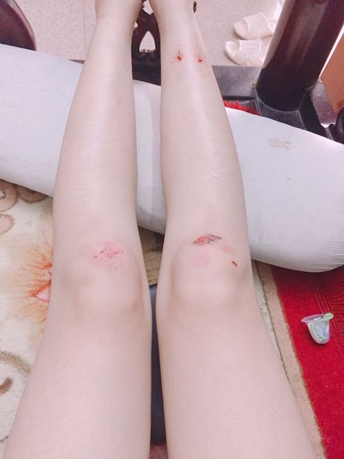 Té xe trầy tay nữ nhẹ: Hướng dẫn sơ cứu và điều trị