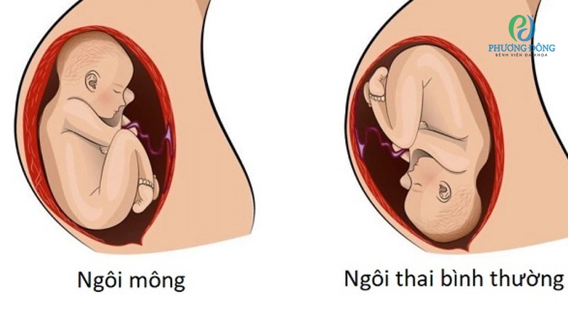 Thai 33 tuần ngôi mông có sao không? Gallery 2