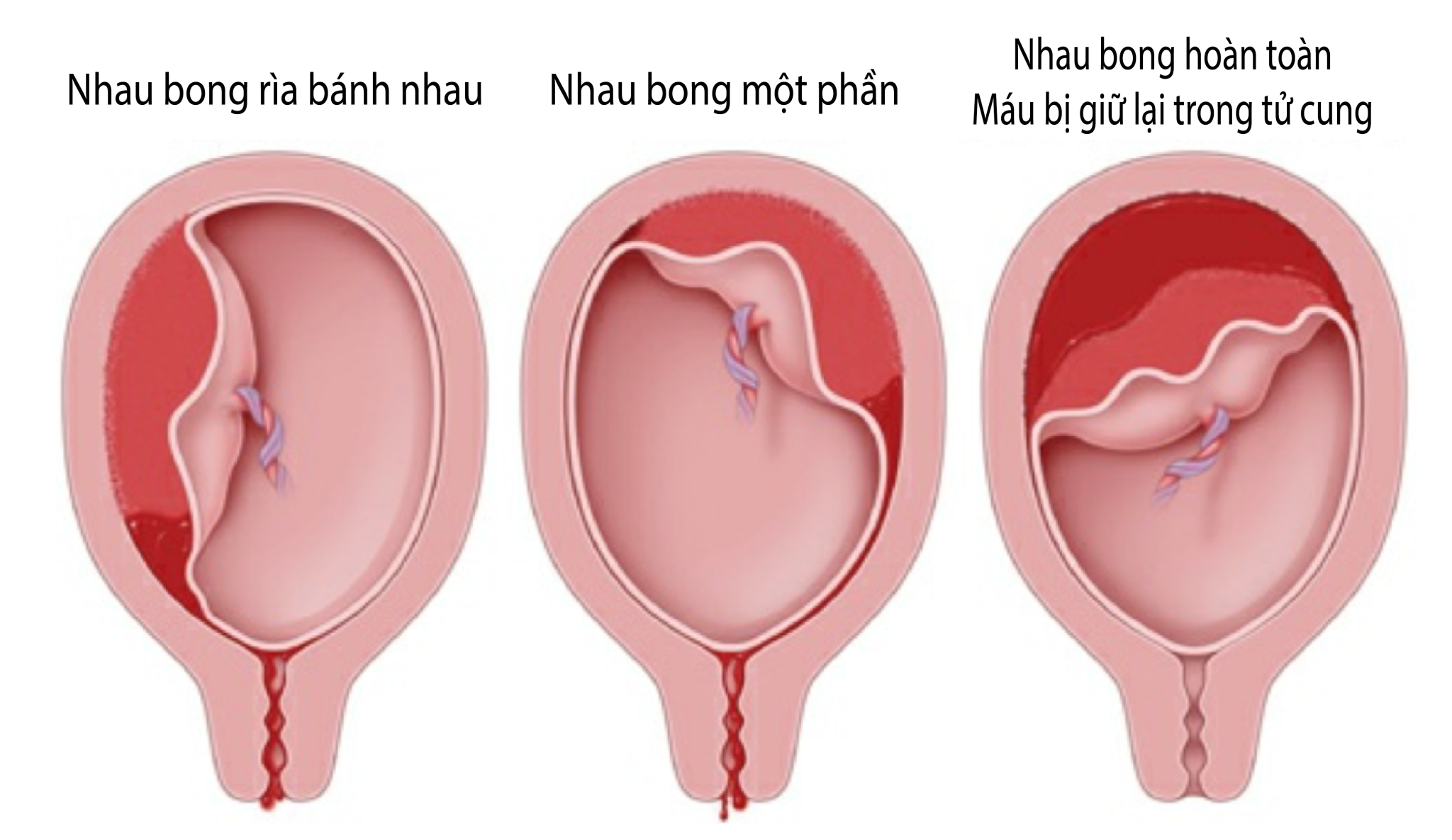 Thai 5 tuần có hiện tượng bong rau