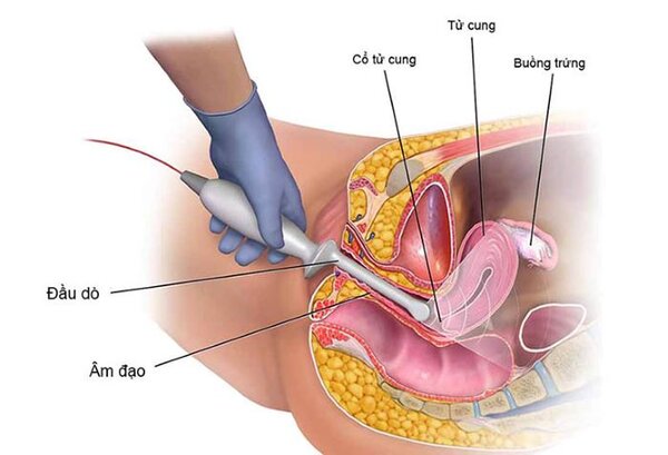 Thai bao nhiêu tuần thì không siêu âm đầu dò?