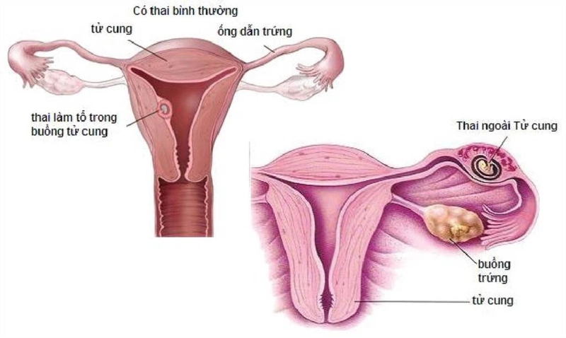 Thai đang làm tổ thử que có lên không?