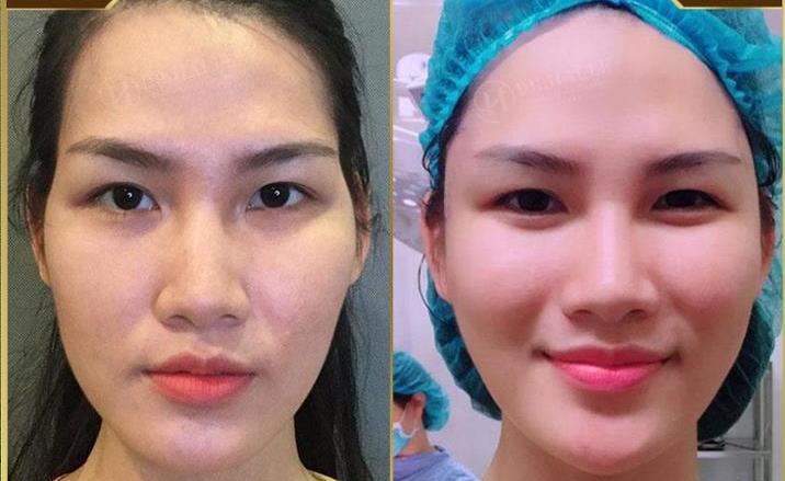 Thái Dương Bị Hóp: Nguyên Nhân, Triệu Chứng Và Cách Điều Trị