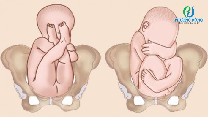 Thai Ngôi Mông Nên Mổ Ở Tuần Bao Nhiêu?