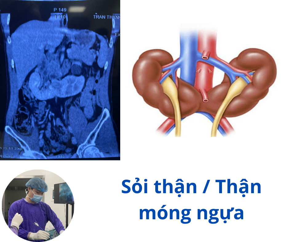 Thận Hình Móng Ngựa Gallery 1