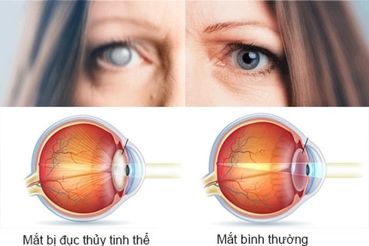 Thay Thủy Tinh Thể Mắt: Giải Pháp Khắc Phục Tật Khúc Xạ Hiệu Quả