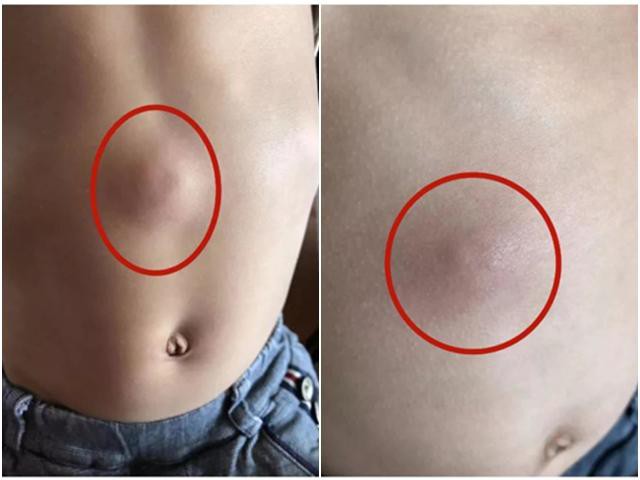 Thỉnh Thoảng Nổi Cục Ở Bụng: Nguyên Nhân, Triệu Chứng Và Cách Xử Lý