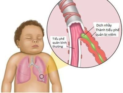 Thở rít khi ngủ