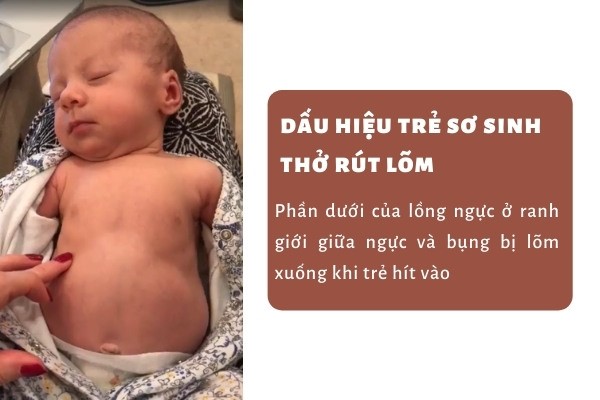 Thở Rút Lõm Ở Trẻ