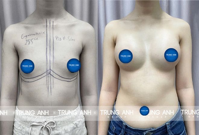 Nâng ngực bao lâu thì được thả rông? Gallery 1
